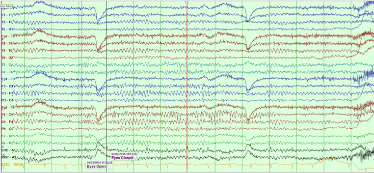 Normal EEG Diagram
